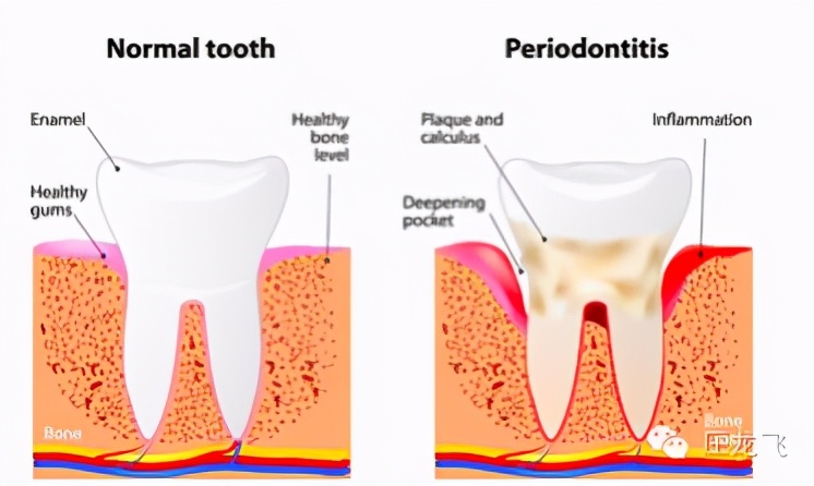 牙周炎维护好牙齿可以用几年,牙周炎严重怎么治疗最有效好得快