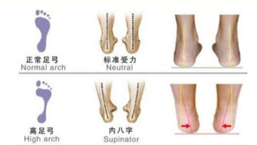 足内翻导致足弓疼,足内翻会导致什么腿型怎么改