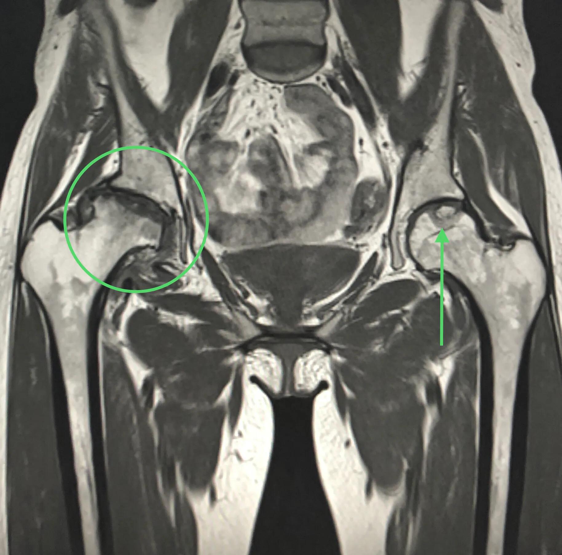 股骨头缺血性坏死的症状及治疗,股骨头缺血性坏死的分期