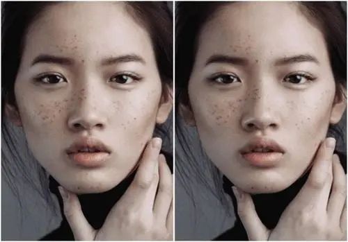 颧骨高面部填充好还是内推好,改善颧骨宽大