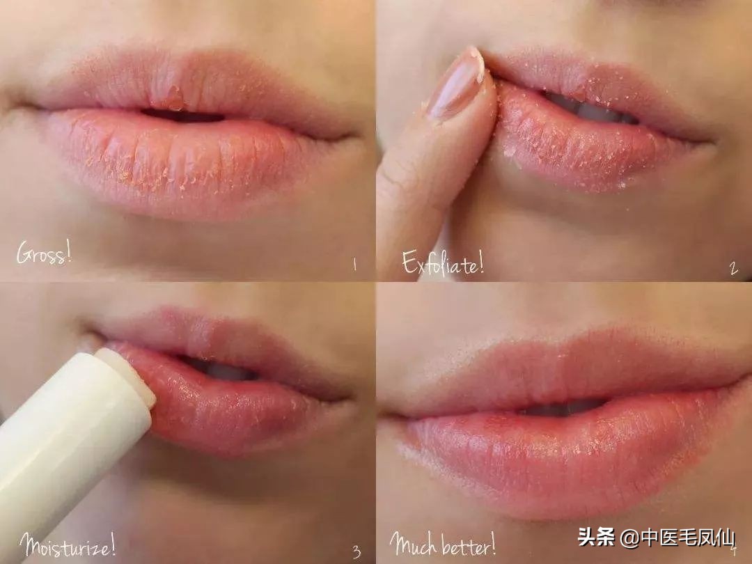 小孩经常喝水嘴唇还是干裂为什么,嘴唇爆皮干裂是脾虚么