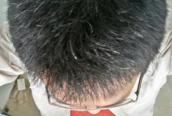 为什么年纪轻轻就头发花白,为什么年纪轻轻就长白头发