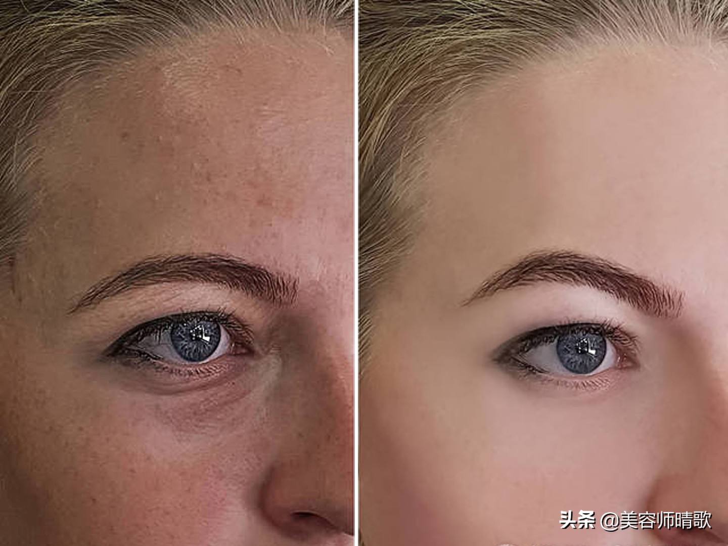 淡斑小白瓶精华二代,小白瓶淡斑精华光感和水感区别