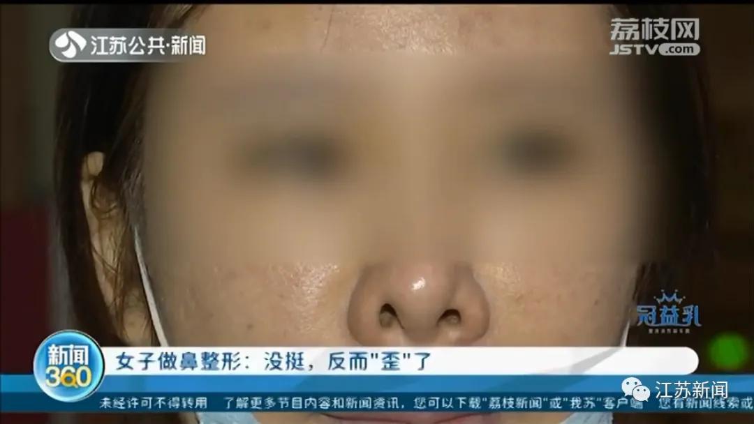 整容鼻子为什么歪了,整容鼻头歪了如何修复