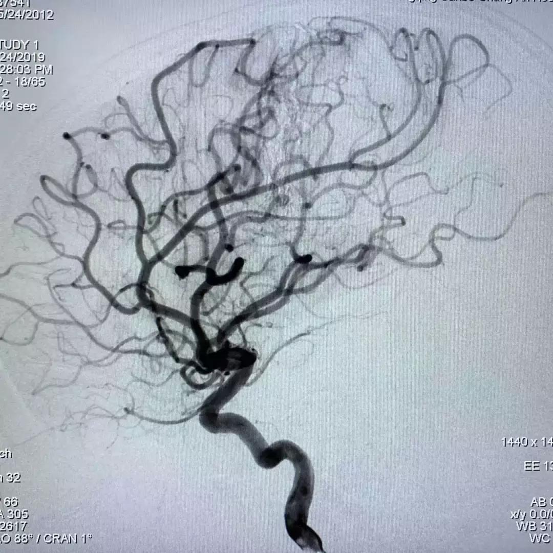 北京三博脑科医院康复治疗,北京三博脑科医院治脑血管瘤怎样