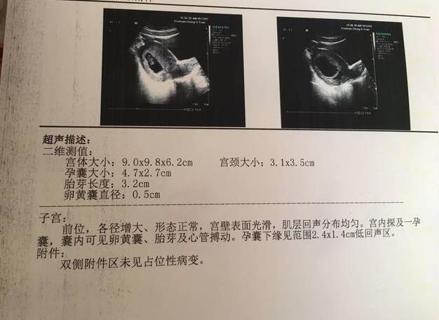b超显示怀孕时间比末次月经晚,孕早期错过了b超预产期怎么办