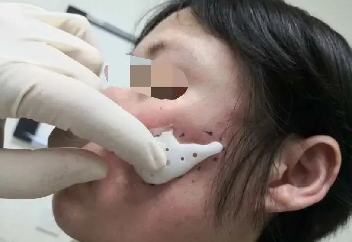 颧弓手术危害,颧骨颧弓手术有后遗症吗