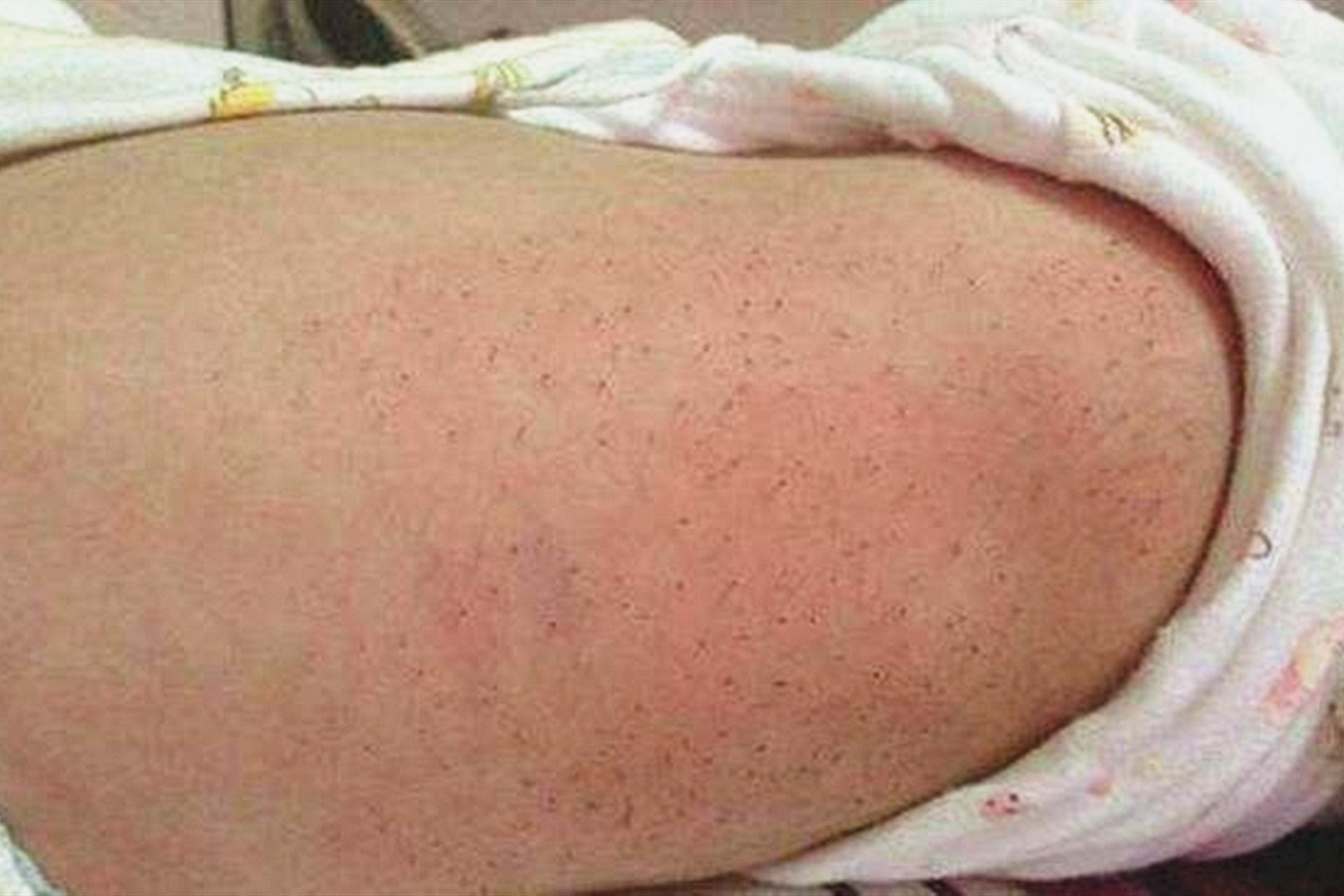 宝宝身上长出红色的小点,小宝宝身上长黑刺