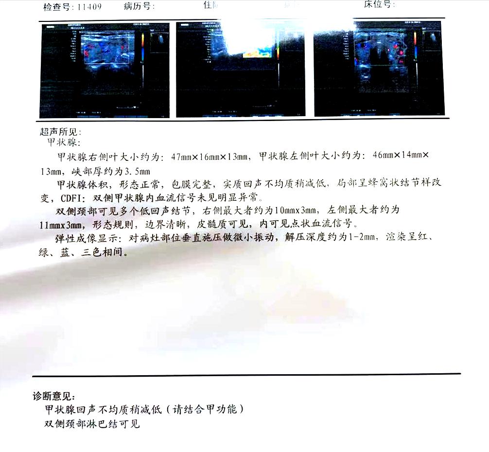 桥本甲减服药治疗效果仍然不佳，心率达到110次/分，真无法可治？