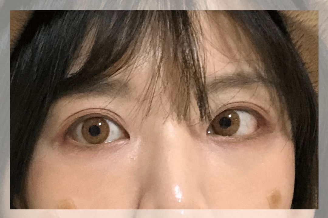 董氏奇穴一针治疗黑眼圈,熊猫针一针就能去掉黑眼圈吗