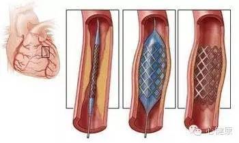 心脏血管，狭窄多少才算严重？