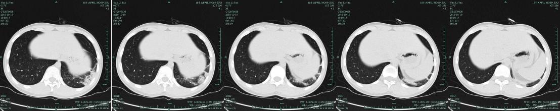 mngs病原检测的优势,mngs真的可靠吗