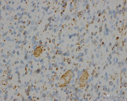 菁讲:你所不知道的横纹肌肉瘤