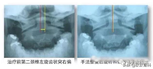 颈椎病治疗的十大误区,颈椎病4大治疗误区你知道吗