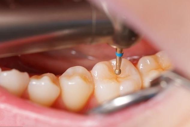 龋病补牙和楔状缺损补牙哪种结实,牙齿楔状缺损怎么补牙用什么材料