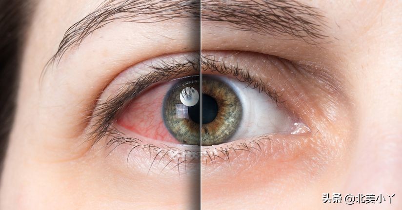 眼科医生3个忠告缓解干眼症,干眼症怎么解决眼科专家来告诉你