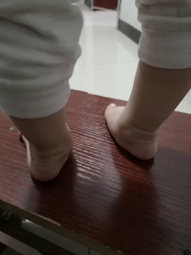 足外翻图片和治疗方法,足外翻需要治疗吗