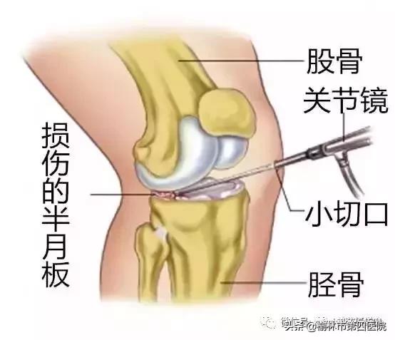 内侧半月板后角损伤怎么治疗,prp治疗半月板损伤有用吗