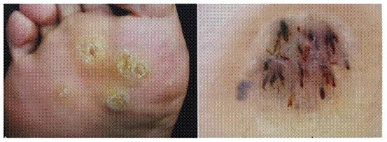 脚上长了个鸡眼它自己会好吗,脚上长的不是鸡眼但是特别疼