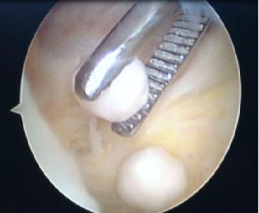 膝关节软骨移植手术风险大吗,膝关节软骨移植手术后多久能康复