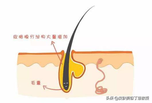 痘痘肌能吃什么油,痘痘肌忌辣每天吃什么