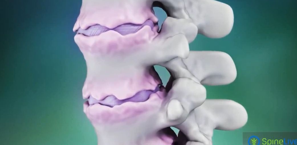 强直不锻炼,强直可以不吃药仅靠锻炼吗