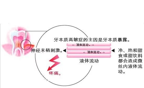 牙本质过敏的临床表现预防和治疗,牙本质过敏症治疗方法是