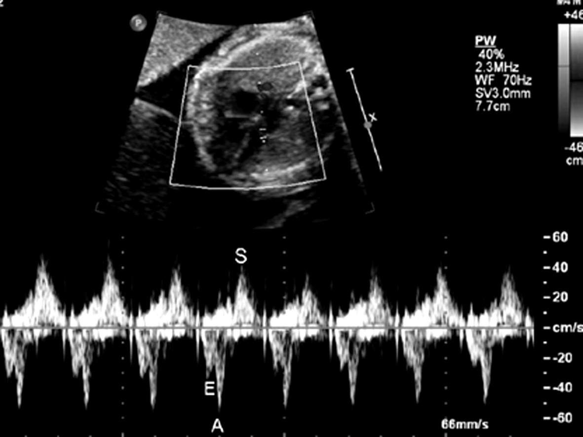 胎儿超声结果显示心跳过速,27周胎儿心律不齐早搏