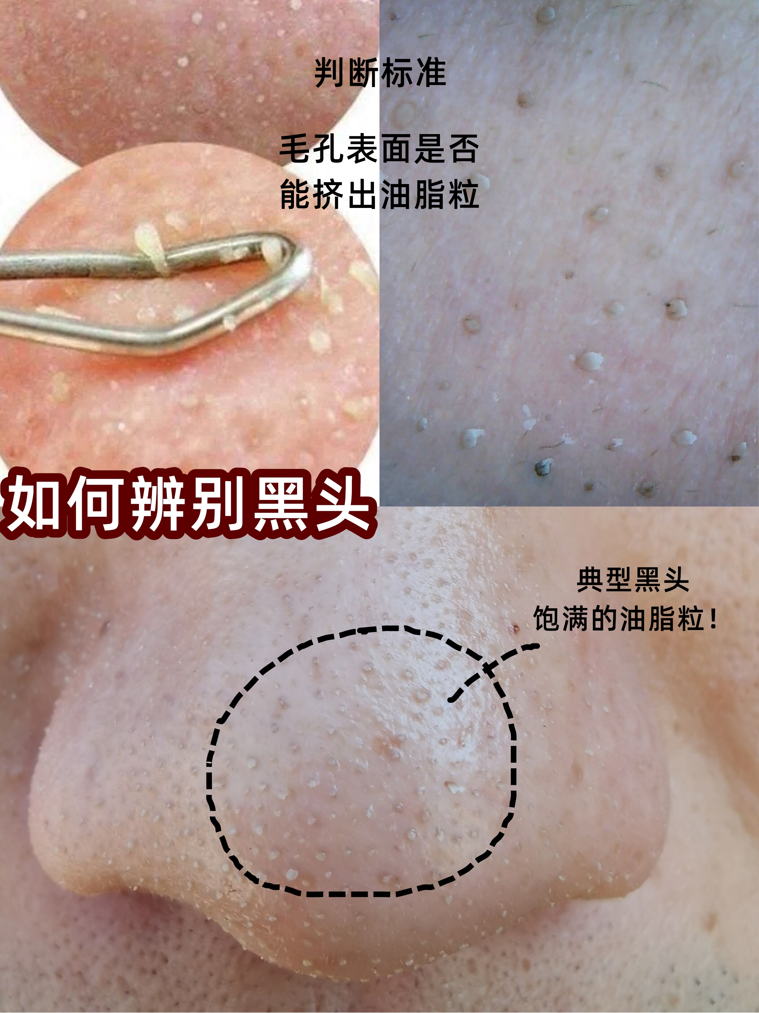 黑头如果不管它会一直在鼻子上吗,不管黑头行吗