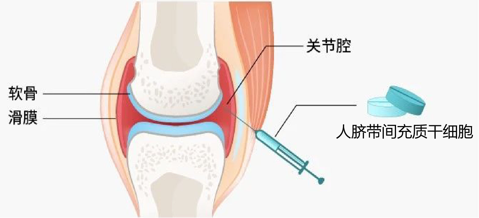 脐带间充质干细胞能治什么病,人脐带间充质干细胞是什么