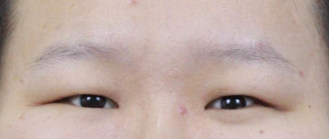 割双眼皮是种什么体验,割双眼皮什么样子才是增生