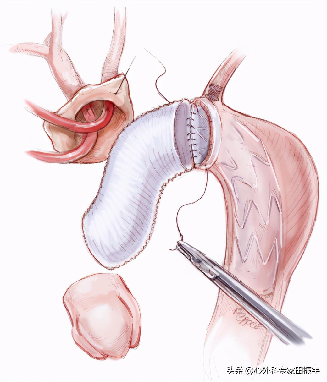 急性B型主动脉夹层合并主动脉破裂的急诊处理