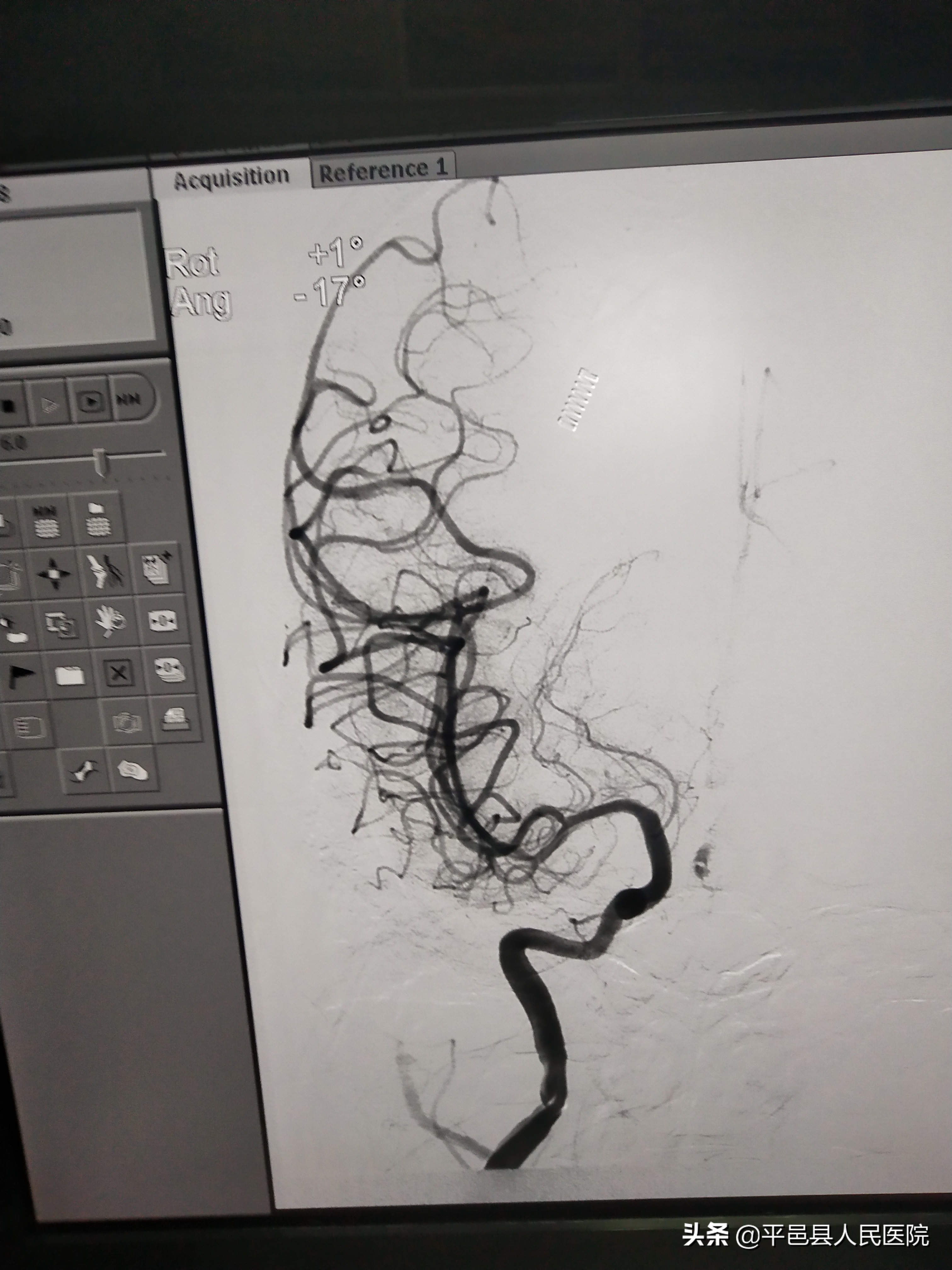 【特色诊疗】平邑人身边放心的“国家级示范防治卒中中心”不负百姓健康重托