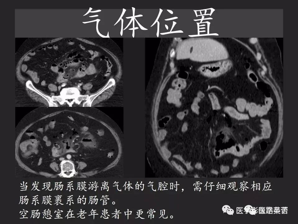 空腔脏器穿孔和胃肠道穿孔区别,腹膜后穿孔一般是哪里穿孔