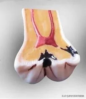 牙齿上面有黑线补牙怎么弄,牙齿有严重黑线怎么补牙