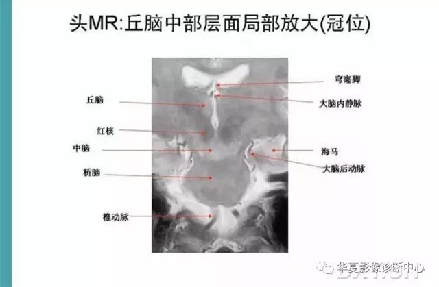 电子版头颅ct与mri断层解剖,头颅mri血管解剖与分段详解