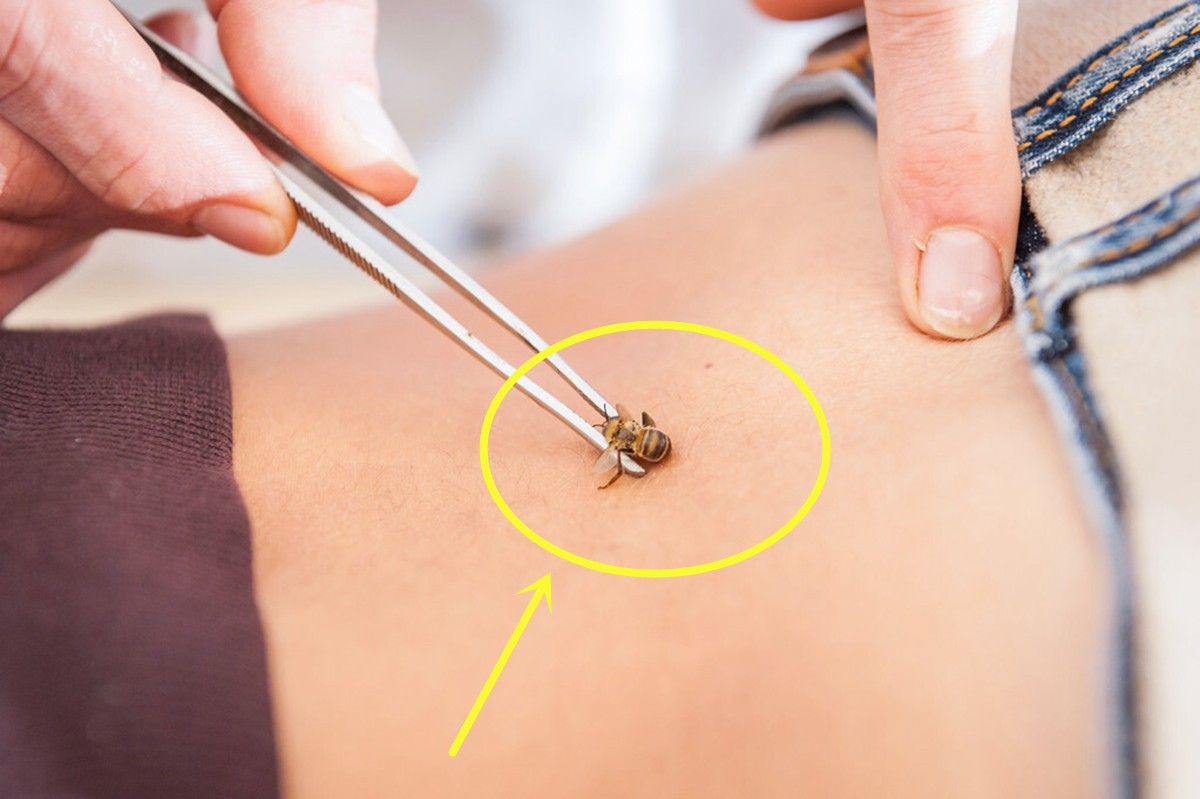 孩子被蜱虫咬头不长头发了,2岁宝宝被蜱虫咬后会哭闹吗