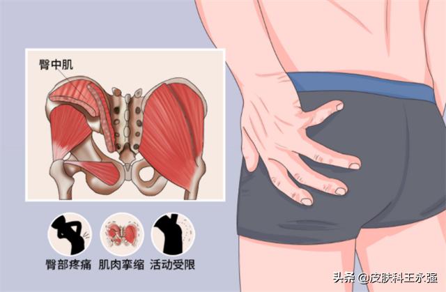 坐久了臀部疼肌肉劳损,久坐臀肌劳损怎么治