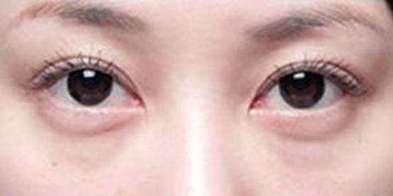 45岁女人适合做哪种祛眼袋方法,生姜祛眼袋的正确方法