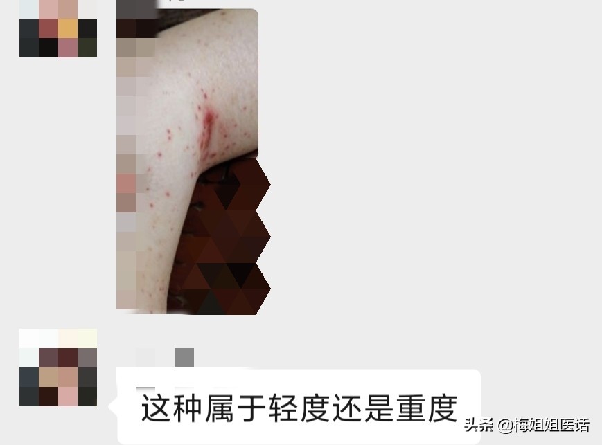 结节性痒疹靶向治疗,靶向药甲沟炎