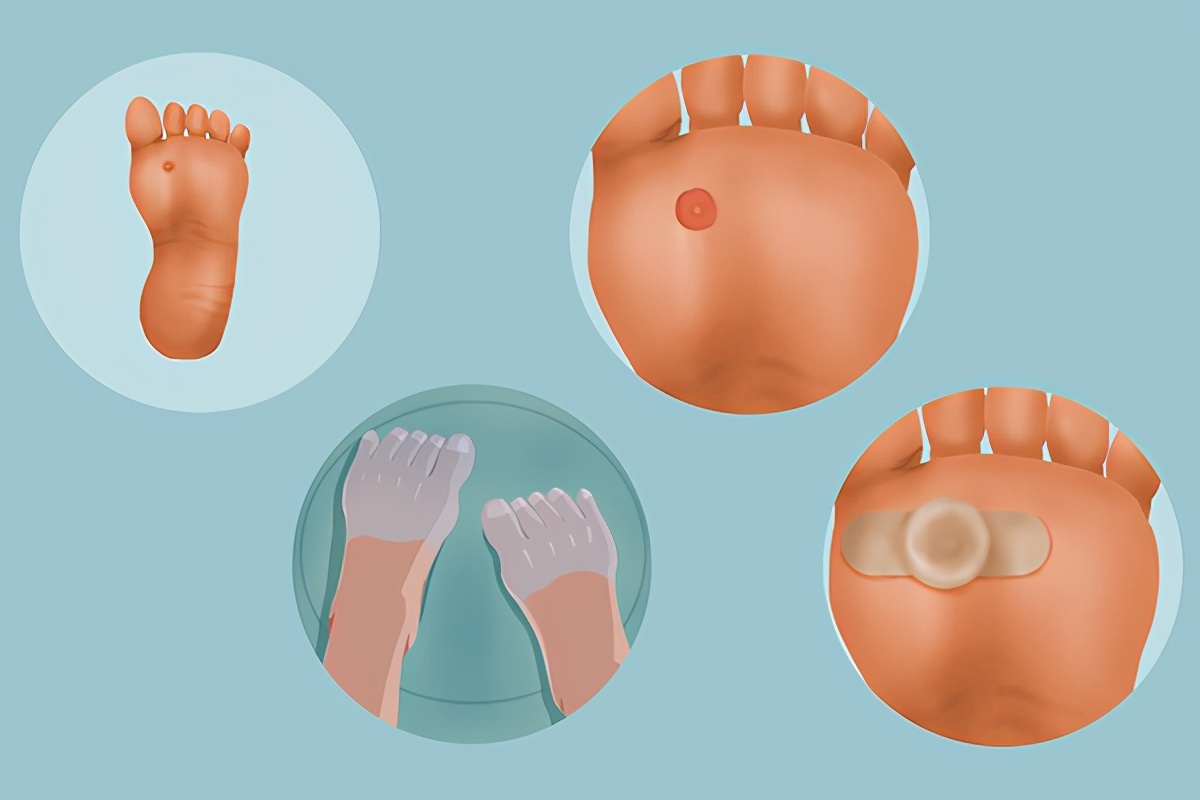 脚上长了鸡眼怎么能快速的去掉,脚上长鸡眼怎么去除鸡眼