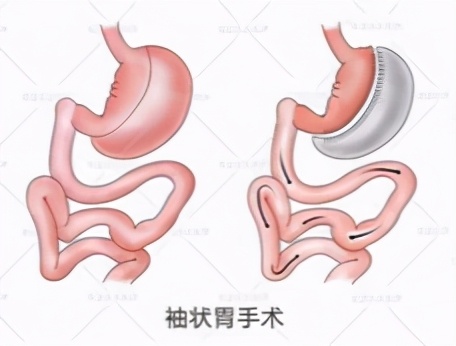 隐性肥胖和显性肥胖的区别,造成肥胖的原因和如何预防肥胖