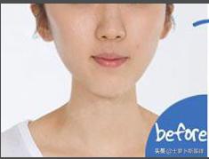 ps处理双下巴几种方式,胖子的双下巴怎么ps