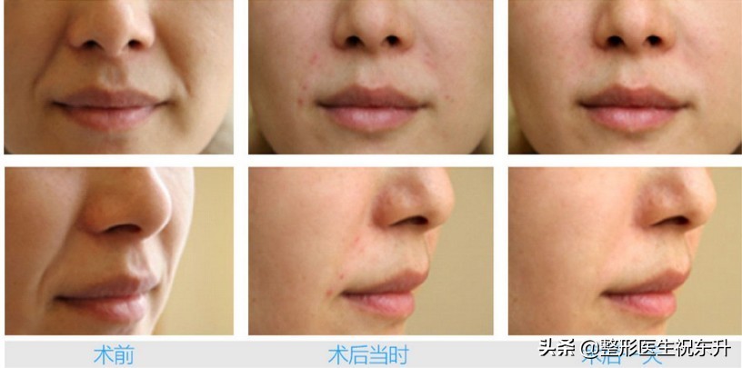 也许从一开始就错了图片,突然有了很深的法令纹