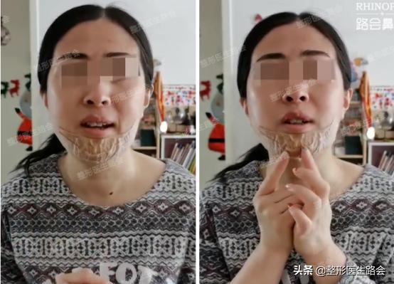 想要垫下巴│材料怎么选？手术疼不疼，过程怎样？听她亲口跟你说