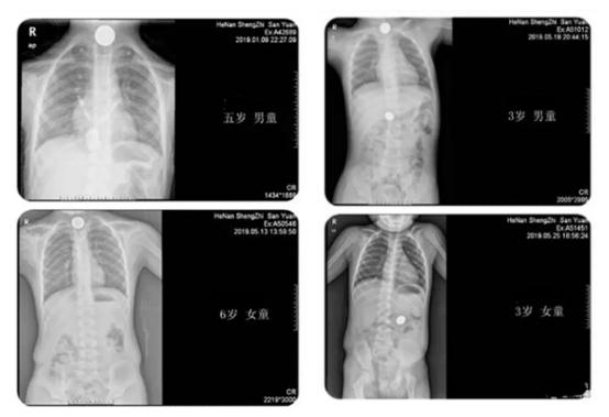 硬币吞了怎么处理,小孩误吞一角硬币