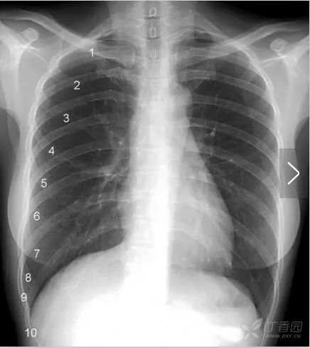 正常胸片图片,正常的胸片讲解
