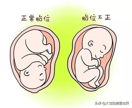 孕期胎位不正准妈妈莫慌张！