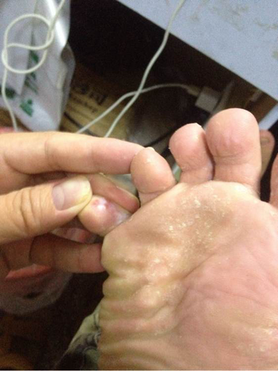 脚气好不了查什么,脚气很重谁知道怎么治疗