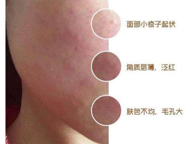 激素脸要怎么洗脸,三天没洗脸脸洗完通红怎么回事